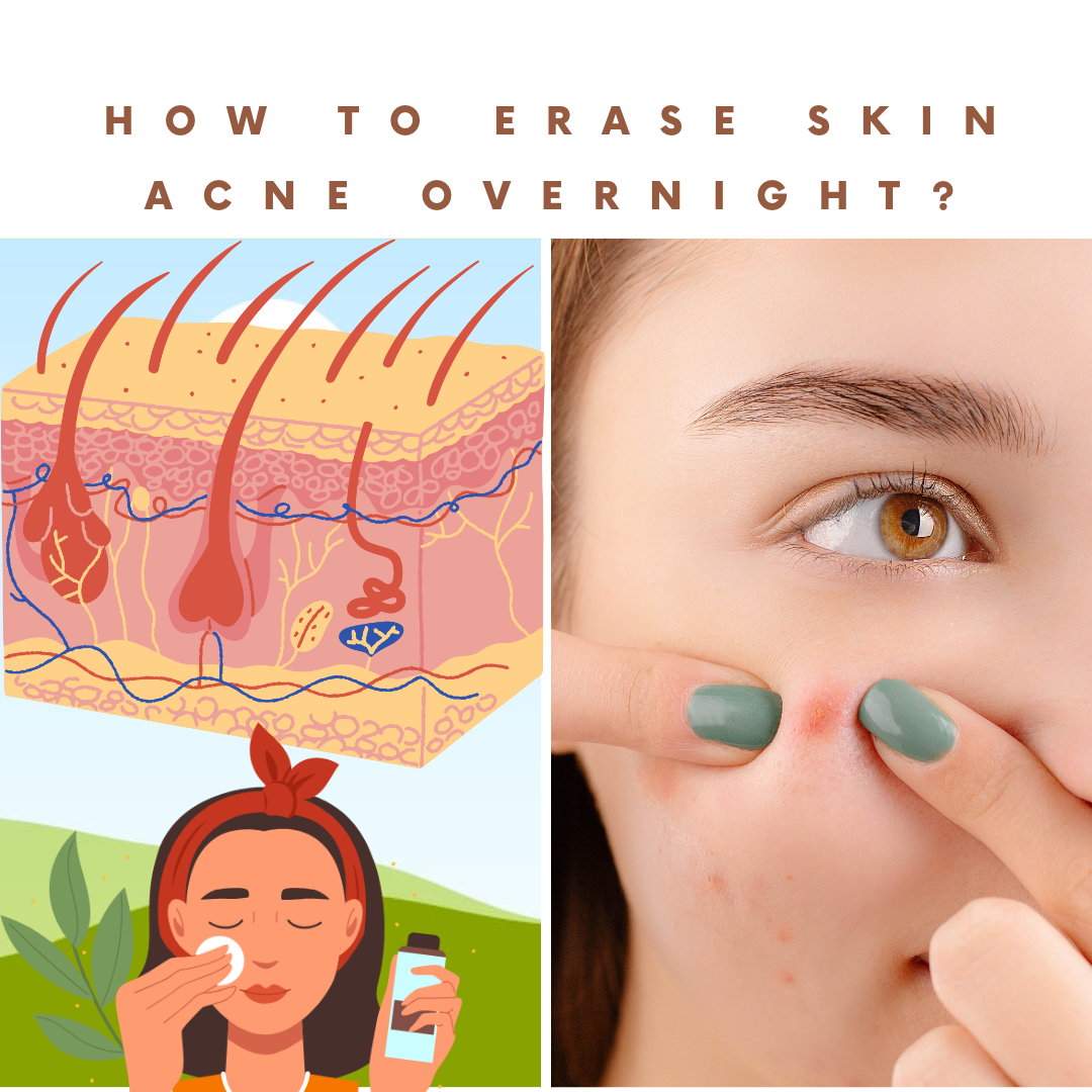 How to Erase Acne Overnight?